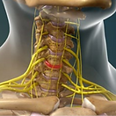 herniated-disc
