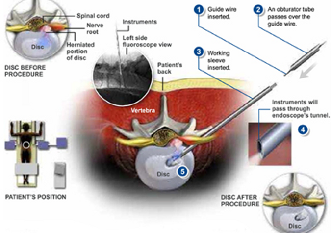 ultra-minimally-invasive