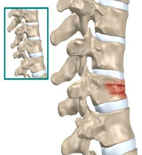 athritis