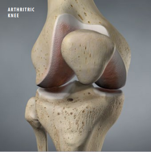 arthritric-knee