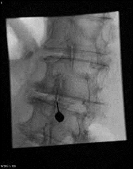 lumbar-facet-joint-injections